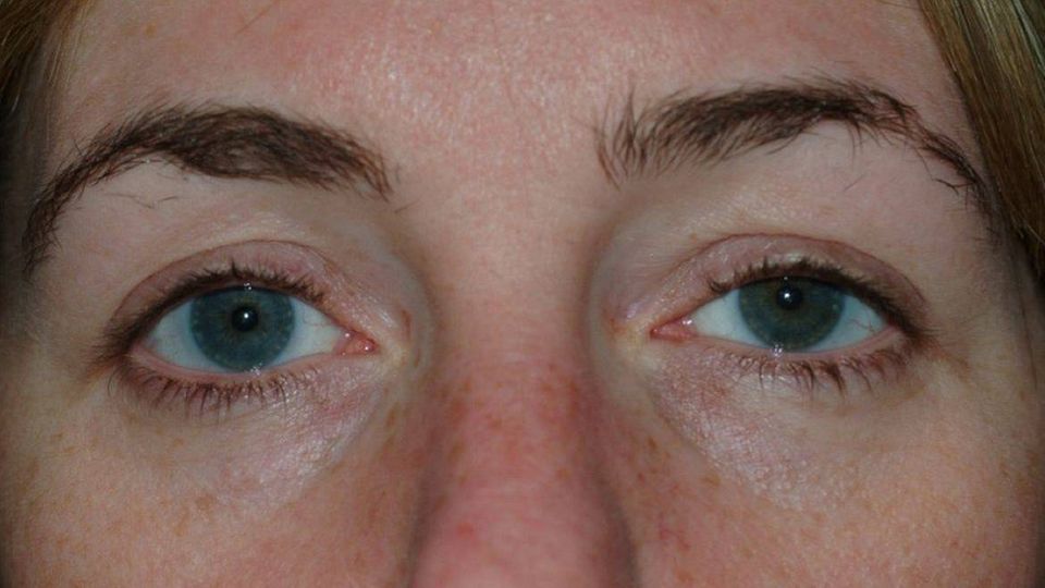 Geschwollenes Auge der Patientin
