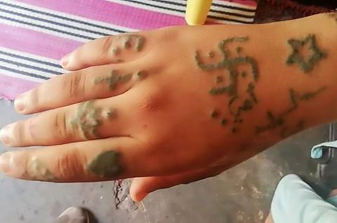 Hakenkreuze und Beleidigungen: In Marokko wurde ein Mädchen mit erniedrigende Tattoos gebrandmarkt 