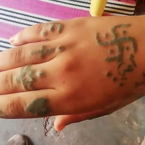 Hakenkreuze und Beleidigungen: In Marokko wurde ein Mädchen mit erniedrigende Tattoos gebrandmarkt 