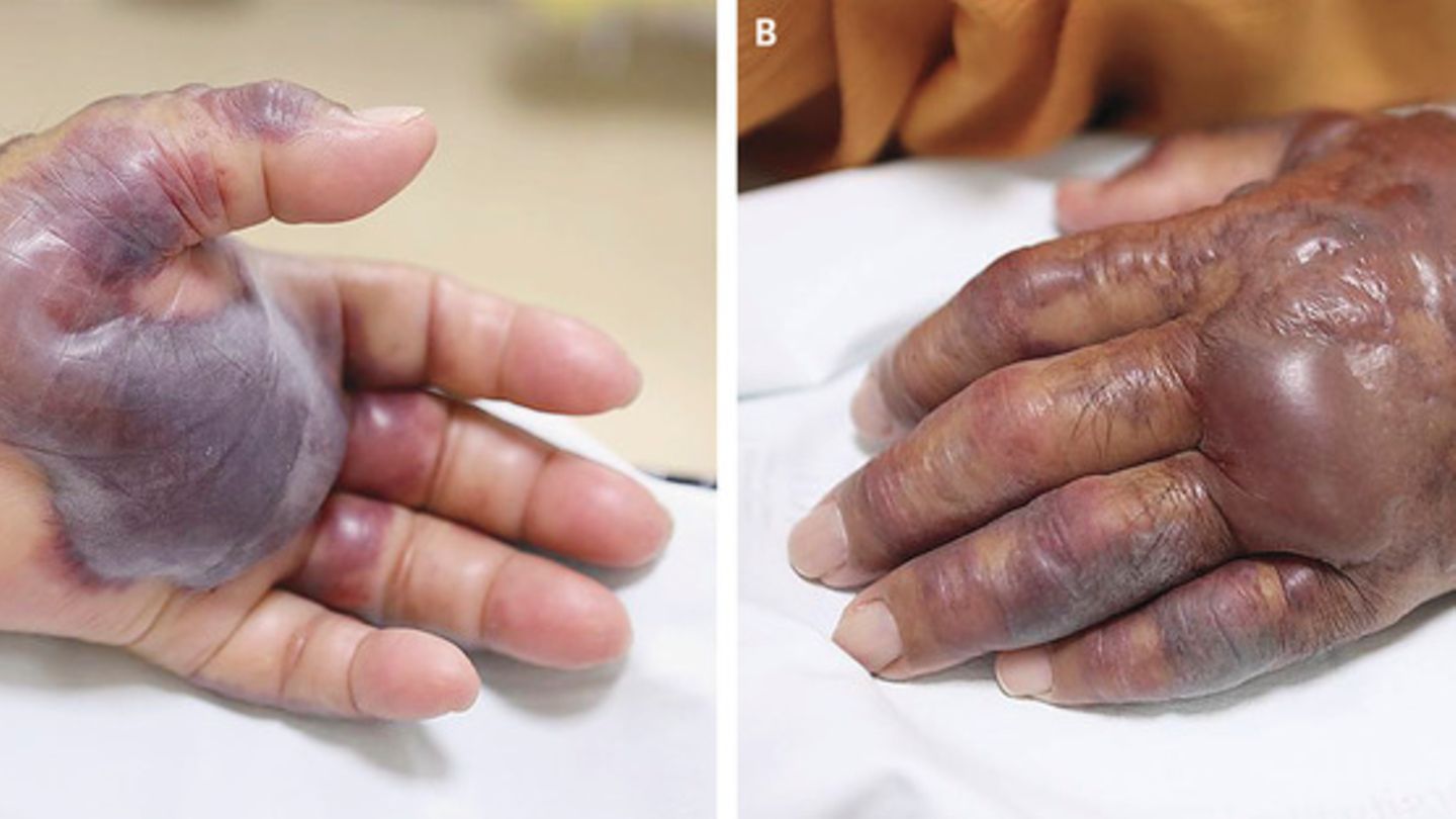 Blaue, geschwollene Hand 