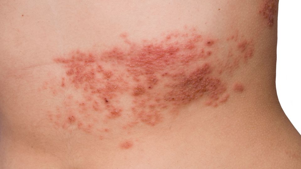 Ein Bauch mit rotem Ausschlag