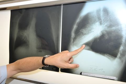 Röntgenbild zeigt mit Krebs befallene Lunge