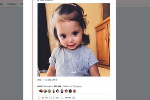 Seltener Gendefekt: Diese Zweijährige hat riesige Augen – doch der Hintergrund ist ernst