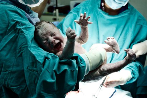 Ein Baby wird von Ärzten per Kaiserschnitt auf die Welt gebracht