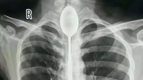 Auf dem Röntgenbild erkennt man den Löffel in der Speiseröhre des Mannes