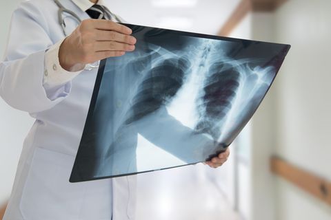 Zwei Jahre nach der Transplantation wurde der Tumor auf einer Röntgenaufnahme entdeckt (Symbolbild).