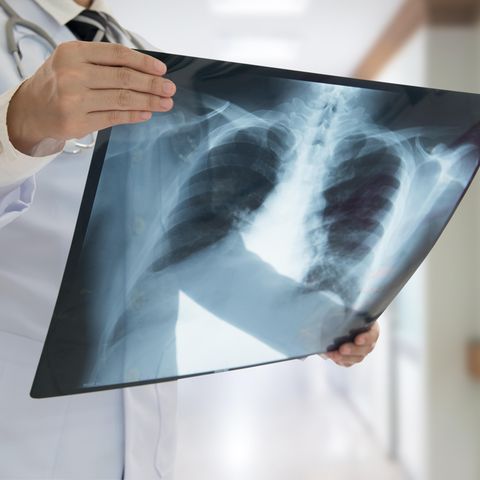 Zwei Jahre nach der Transplantation wurde der Tumor auf einer Röntgenaufnahme entdeckt (Symbolbild).