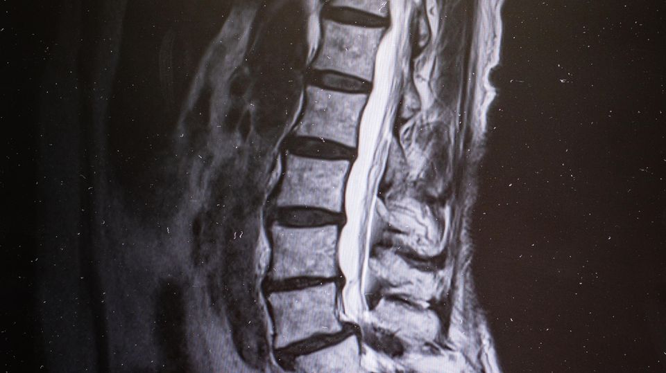 Die Kernspinaufnahme zeigt die Einengung des Nervenkanals, der innerhalb der Wirbelsäule verläuft. Fachbegriff: Spinalkanalstenose