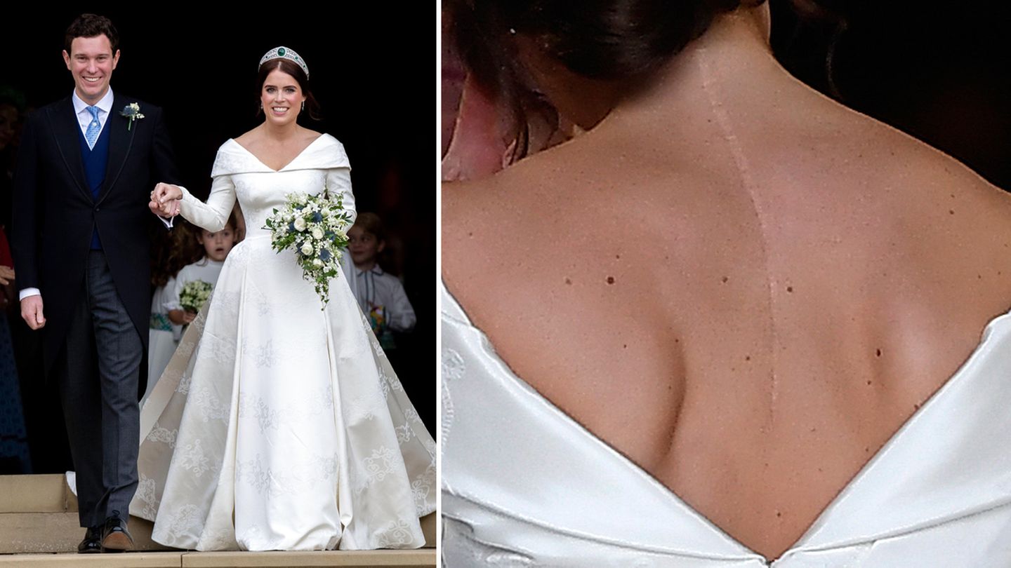 Stylewatch: Hochzeit von Prinzessin Eugenie und Jack Brooksbank, Schloss Windsor Fünf Monate nach ihrem Cousin Prinz Harry heiratete auch Prinzessin Eugenie auf Schloss Windsor. Für ihre Trauung mit dem Unternehmer Jack Brooksbank ließ sich die 28-Jährige von Designer Peter Pilotto eine Seidenrobe schneidern. Spektakulär war nicht nur die meterlange Schleppe, sondern auch die Rückenansicht: Eugenie wählte ein Kleid, das ihre Narbe zwischen den Schulterblättern offenbarte. Im Alter von zwölf Jahren musste die Tochter von Prinz Andrew operiert werden, weil sie an Skoliose leidet, einer Verkrümmung der Wirbelsäule. Hochzeit von Prinzessin Eugenie und Jack Brooksbank, Schloss Windsor Fünf Monate nach ihrem Cousin Prinz Harry heiratete auch Prinzessin Eugenie auf Schloss Windsor. Für ihre Trauung mit dem Unternehmer Jack Brooksbank ließ sich die 28-Jährige von Designer Peter Pilotto eine Seidenrobe schneidern. Spektakulär war nicht nur die meterlange Schleppe, sondern auch die Rückenansicht: Eugenie wählte ein Kleid, das ihre Narbe zwischen den Schulterblättern offenbarte. Im Alter von zwölf Jahren musste die Tochter von Prinz Andrew operiert werden, weil sie an Skoliose leidet, einer Verkrümmung der Wirbelsäule.
