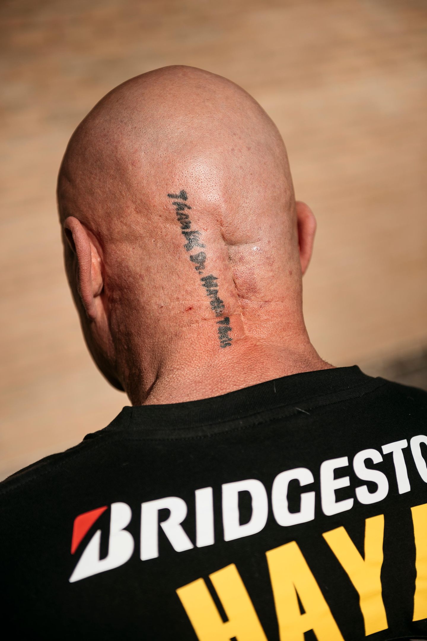 Die Narbe am Schädel und das Tattoo, mit dem Geulen seinem Chirurgen dankt – "Thanx Dr. Martin Theis"