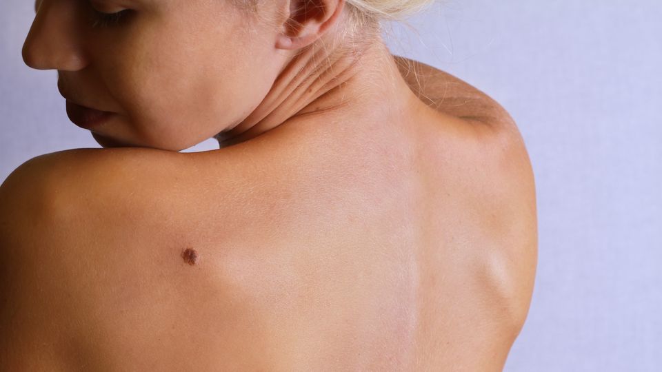 Ist ein Leberfleck gut- oder bösartig? Eine Möglichkeit, dies herauszufinden, ist das Hautkrebs-Screening beim Hautarzt.