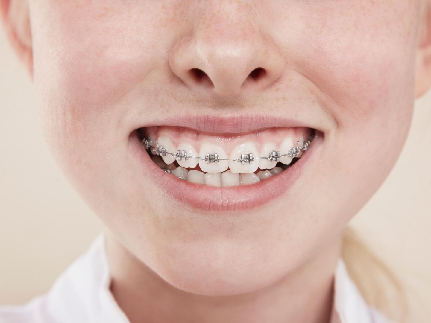 Ich habe meine Zahnspange gehasst – und bin ihr doch sehr dankbar | STERN.de