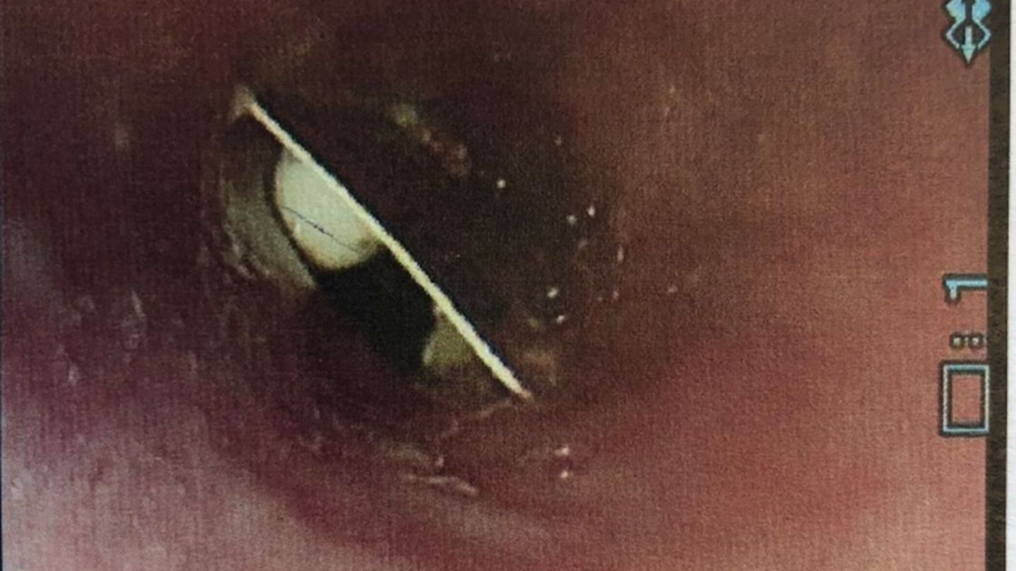 Eine Schmerzmittelverpackung steckt in der Speiseröhre fest