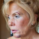 Spitz' Mutter hat Blessuren im Gesicht an Kinn und Augenbraue