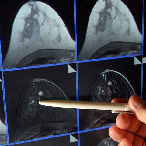 Magnetresonanz-(MR)-Mammographie: ein winziger Tumor in der Brust einer Patientin