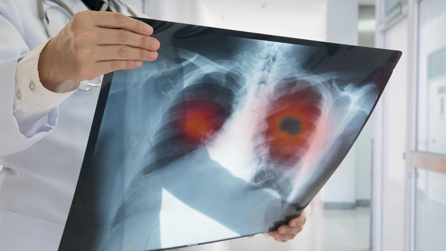 Report Mainz: Seriously ill without knowing it – many diseases are recognized too late in the pandemic