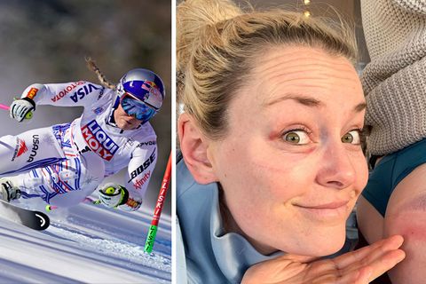 Lindsey Vonn präsentiert den blauen Fleck ihrer Teamkollegin