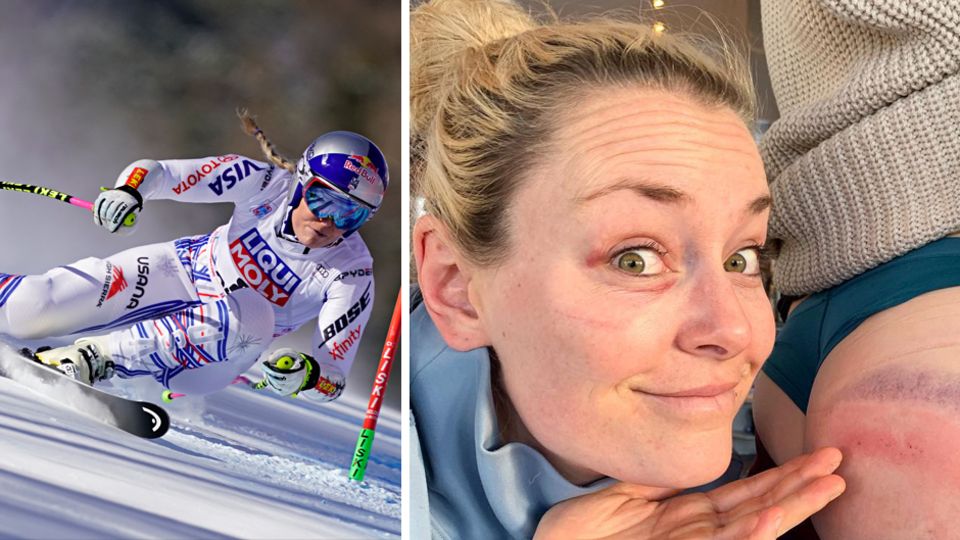 Lindsey Vonn präsentiert den blauen Fleck ihrer Teamkollegin