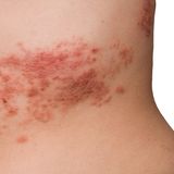 Typische Symptome der Gürtelrose