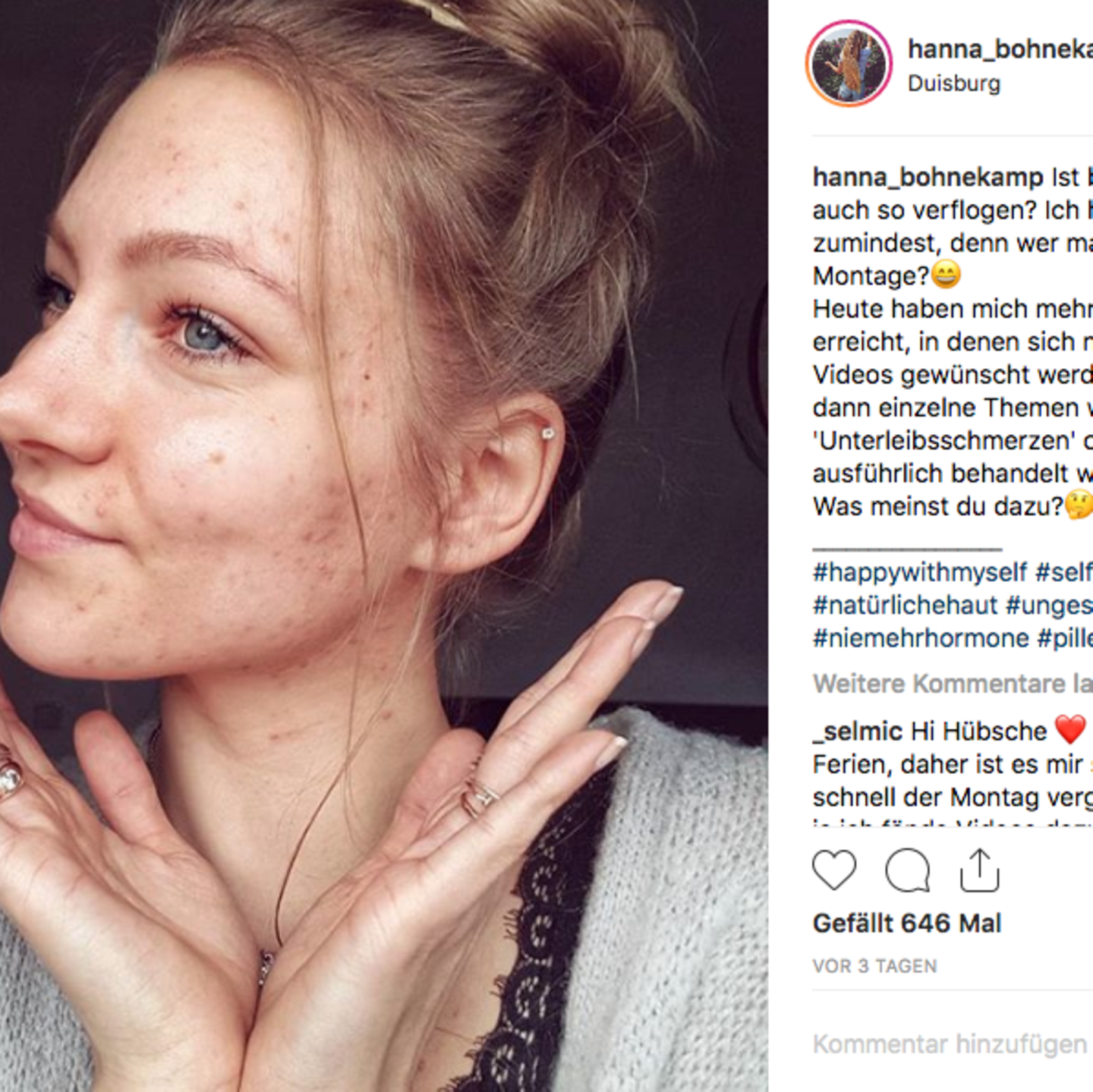 Ex Gntm Model Zeigt Auf Instagram Wie Ihre Haut Nach Absetzen Der Pille Aussieht Stern De