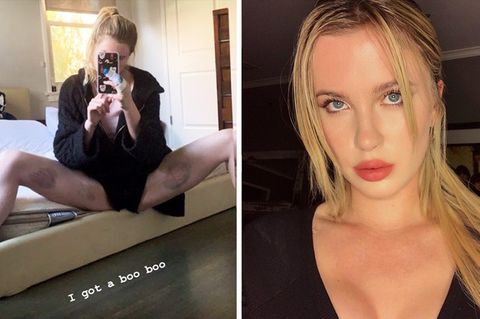 Ireland Baldwin zeigt ihre blauen Flecken auf Instagram