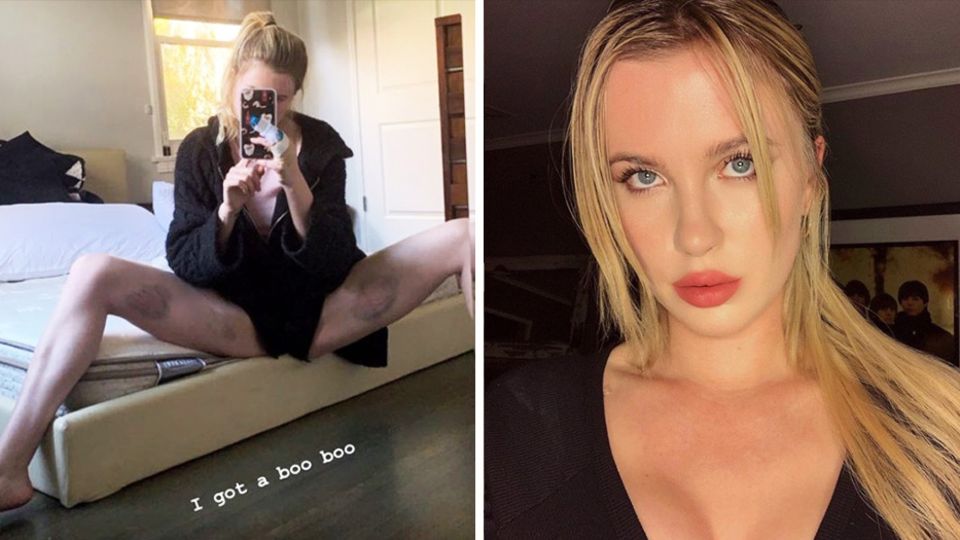 Ireland Baldwin zeigt ihre blauen Flecken auf Instagram Ireland Baldwin zeigt ihre blauen Flecken auf Instagram