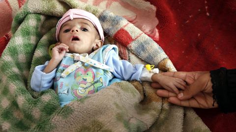 Ein Kind liegt auf einer Station eines Mangelernährungszentrums in Jemens Hauptstadt Sanaa