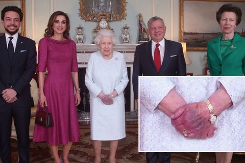 Die linke Hand der britischen Queen ist purpurfarbend angelaufen.
