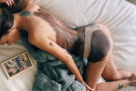 Inspirierende Geschichte: Wegen ihrer Muttermale wurde sie "Dalmatiner" genannt - heute ist Yulianna ein Instagram-Star