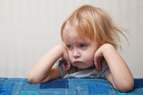 Windpocken: Schulverbot für nicht geimpfte Kinder verhängt