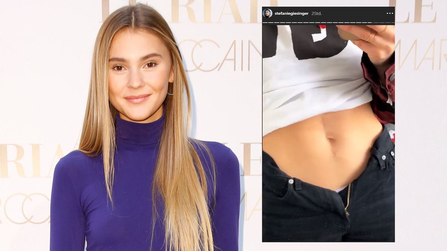 Stefanie Giesinger Zeigt Ihre Narbe Ein Jahr Nach Der Schweren Op Stern De