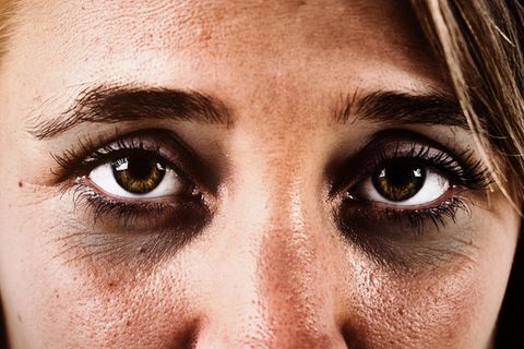 Gesundheit: Ausreichend geschlafen und trotzdem Augenringe? Das könnten die Ursachen sein