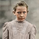 Ein kleines Mädchen mit einer sonnenstrossenartigen Pigmentstörung im Gesicht