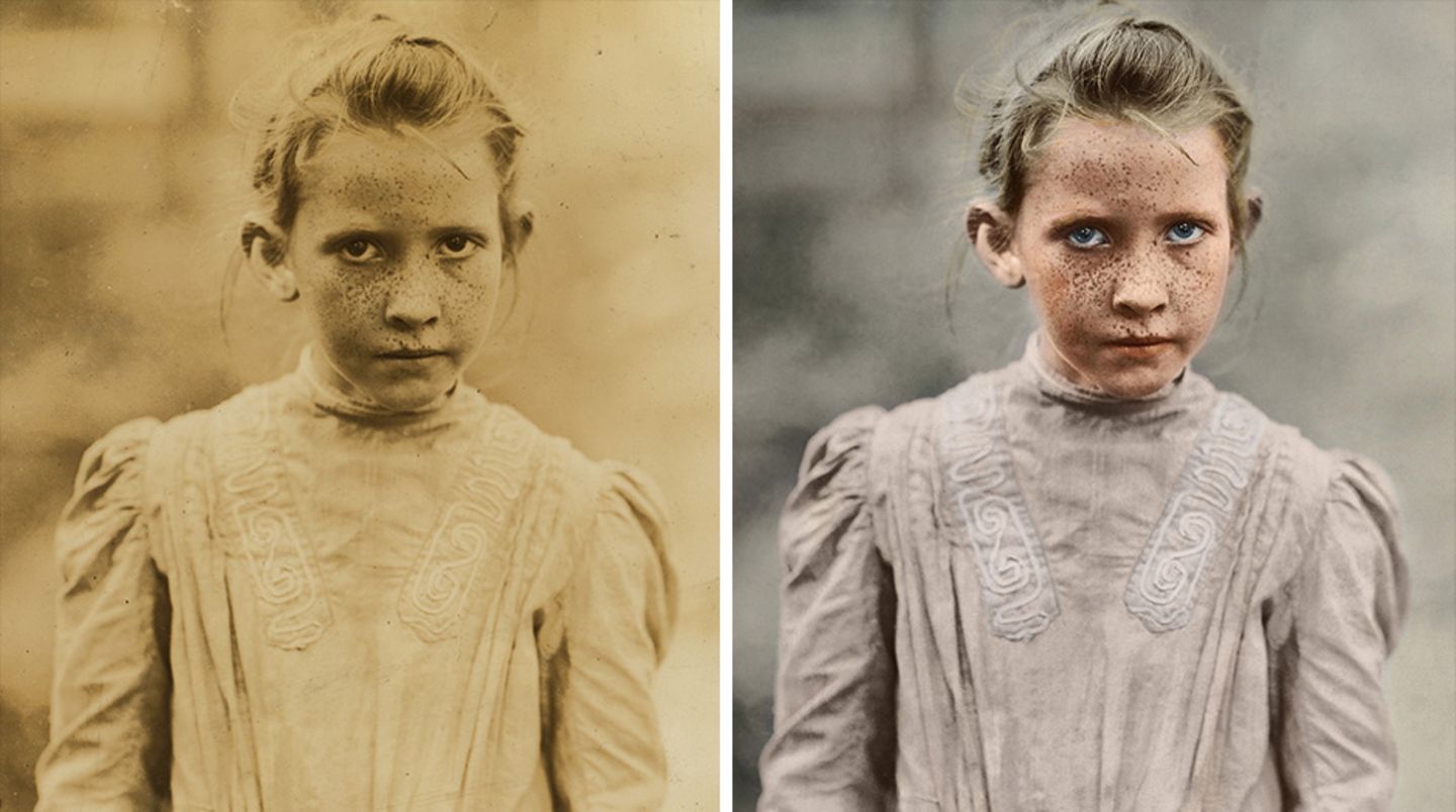 Ein kleines Mädchen mit einer sonnenstrossenartigen Pigmentstörung im Gesicht