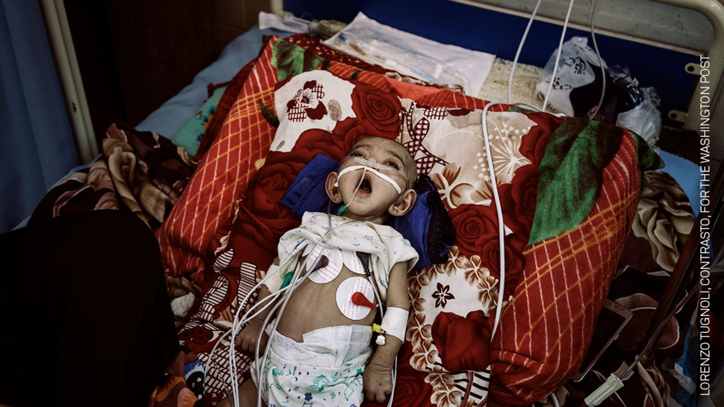 Gewinner in der Kategorie General News Stories: Ein kleines Mädchen schnappt nach Luft im al-Sadaga Hospital in Aden. Es hat einen Herzfehler und benötigt dauerhafte medizinische Hilfe, doch aufgrund des Krieges im Jemen ist die Versorgung mit Sauerstoff und Medikamenten in den Krankenhaus nicht gewährleistet.