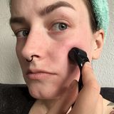 Microneedling für zu Hause: Hilft der Dermaroller gegen Pickelmale?