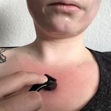 Microneedling für zu Hause: Hilft der Dermaroller gegen Pickelmale?