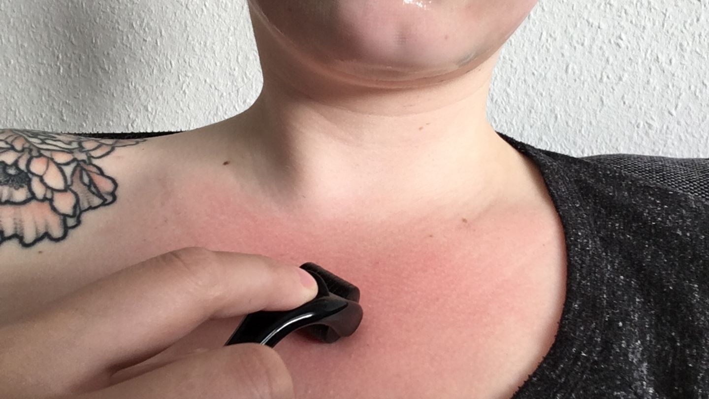 Microneedling für zu Hause: Hilft der Dermaroller gegen Pickelmale?