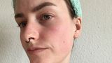 Microneedling für zu Hause: Hilft der Dermaroller gegen Pickelmale?