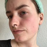 Microneedling für zu Hause: Hilft der Dermaroller gegen Pickelmale?