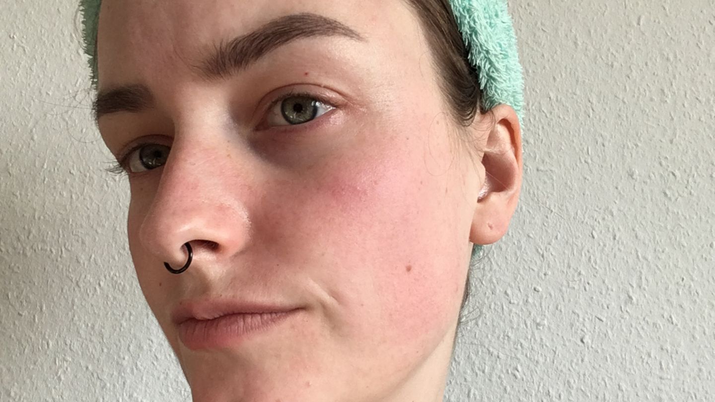 Microneedling für zu Hause: Hilft der Dermaroller gegen Pickelmale? Microneedling für zu Hause: Hilft der Dermaroller gegen Pickelmale?