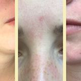 Microneedling: Mit dem Dermaroller gegen Pickelmale