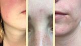 Microneedling: Mit dem Dermaroller gegen Pickelmale