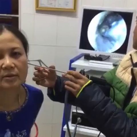 Befund in Vietnam: Frau geht wegen Ohrenschmerzen zum Arzt – was der im Gehörgang findet, kann fliegen