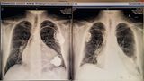 Organspende