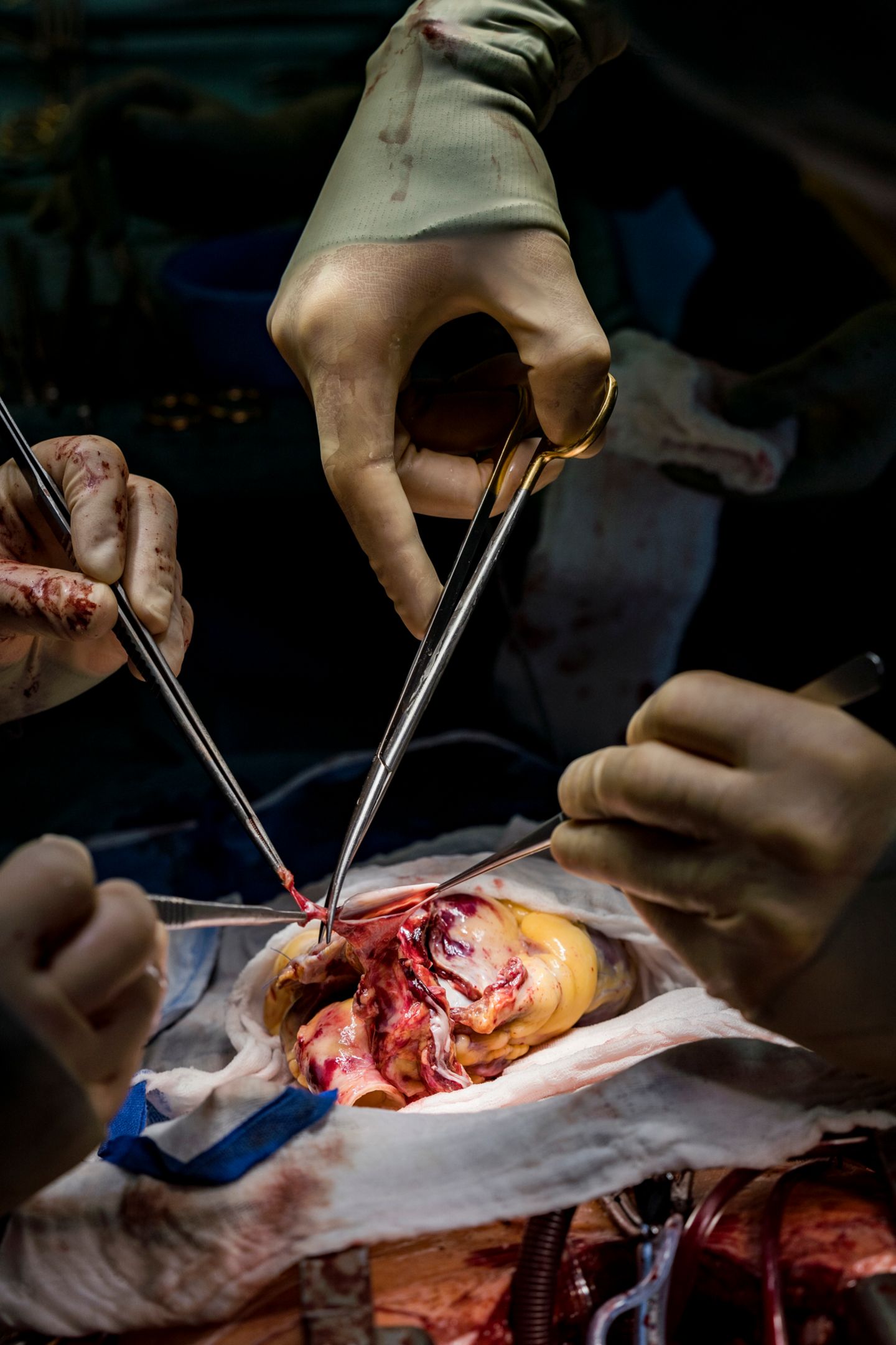 Organspende