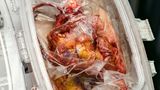 Organspende