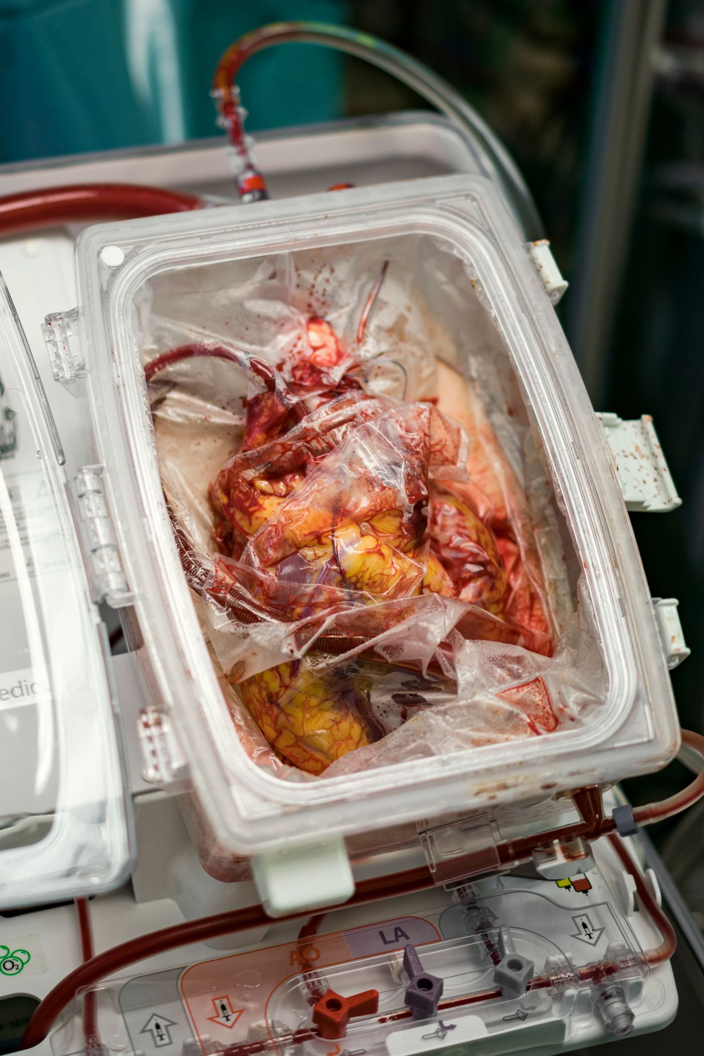 Organspende Ein Herz Wird Verpflanzt Stern De