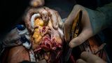 Organspende