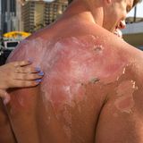 Sonnenverbrannter Rücken eines jungen Mannes wird eingecremt